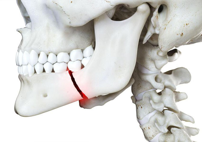 Tratamiento de Trauma Facial - Caso 1