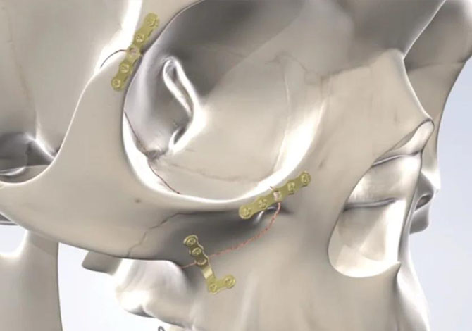 Tratamiento de Trauma Facial - Caso 2