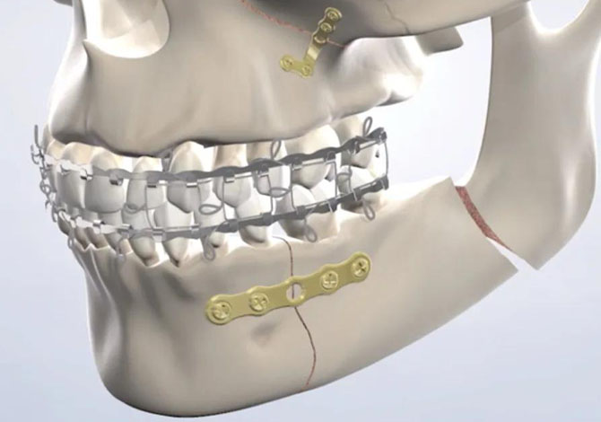 Tratamiento de Trauma Facial - Caso 3